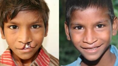 नई दिल्ली: जन्मजात कटे होंठों पर फिर लौटेगी खूबसूरत मुस्कान