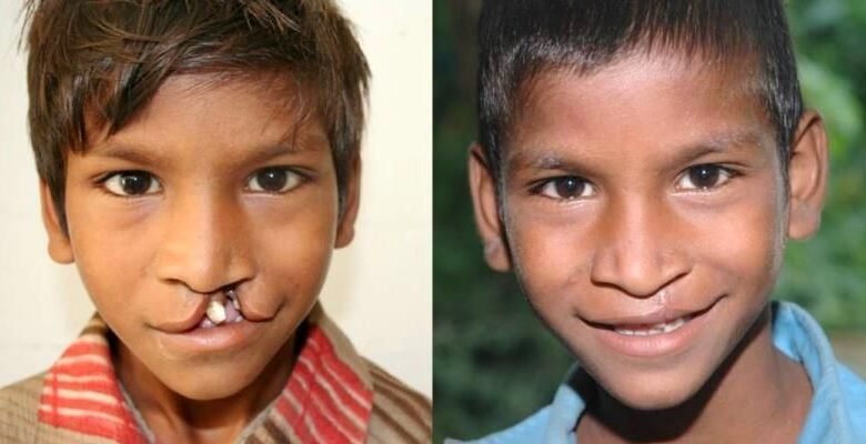 नई दिल्ली: जन्मजात कटे होंठों पर फिर लौटेगी खूबसूरत मुस्कान