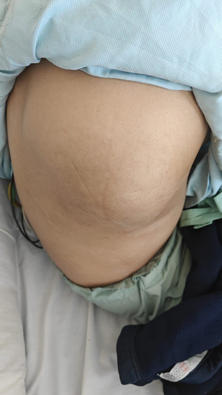 Bone Cancer: दुर्लभ बोन कैंसर से जूझ रही 17 वर्षीय किशोरी ने जीती जिंदगी की जंग, फोर्टिस अस्पताल के डॉक्टरों ने बचाई जान