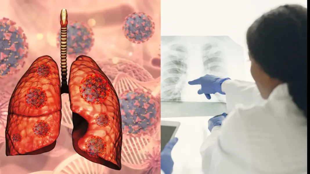Lung Failure Clinic: फेफड़ों के गंभीर मरीजों को एक छत के नीचे मिलेगा ट्रांसप्लांट तक का इलाज, दिल्ली में शुरू हुई विशेष सुविधा Lung Failure Clinic: फेफड़ों के गंभीर मरीजों को एक छत के नीचे मिलेगा ट्रांसप्लांट तक का इलाज, दिल्ली में शुरू हुई विशेष सुविधा